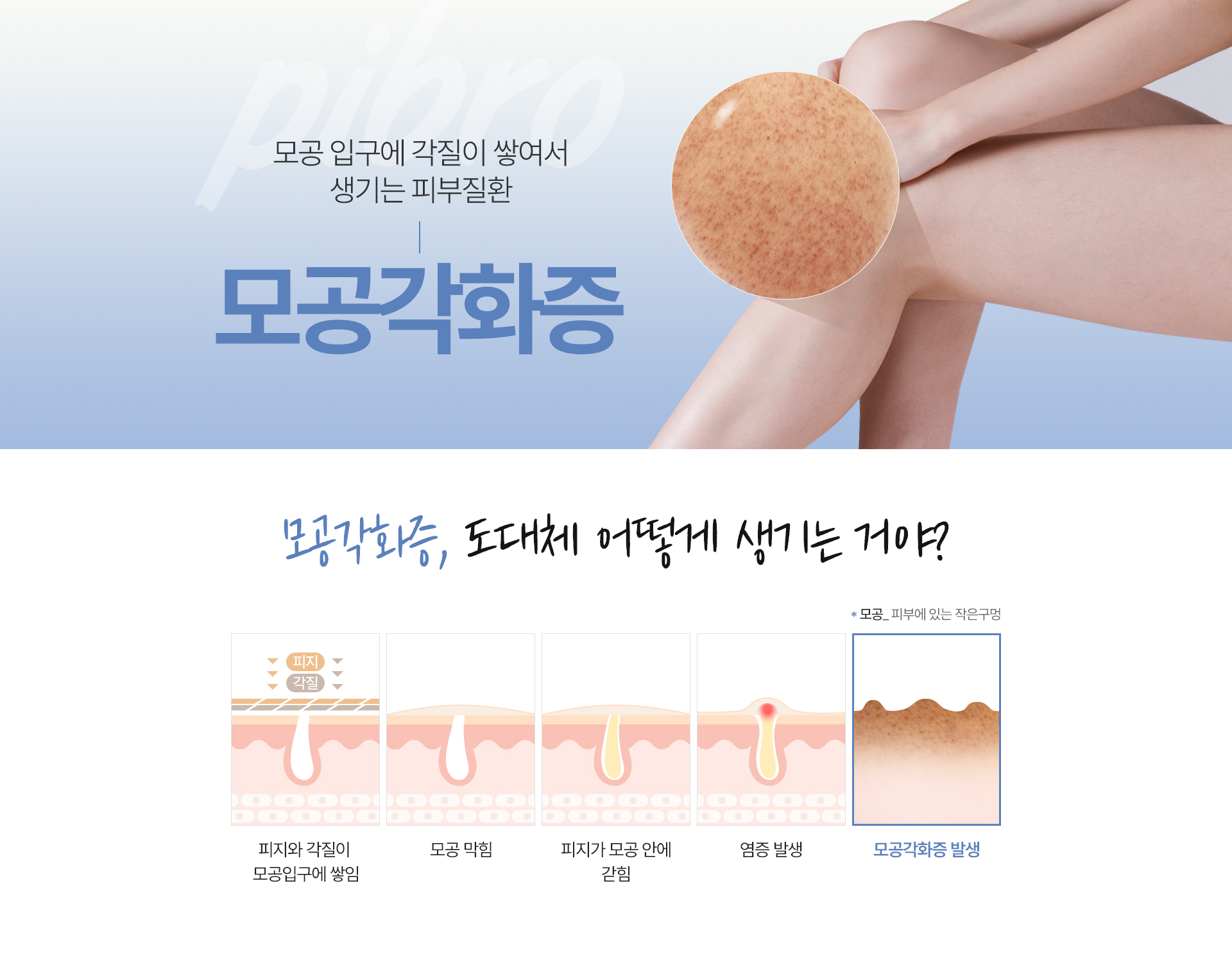 모공각화증 치료